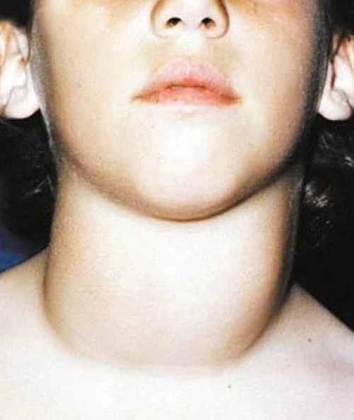 Толстая шея признак. Эндемический зоб щитовидной. Гипертиреоз щитовидной железы симптомы у детей. Эутиреоидный зоб у детей.
